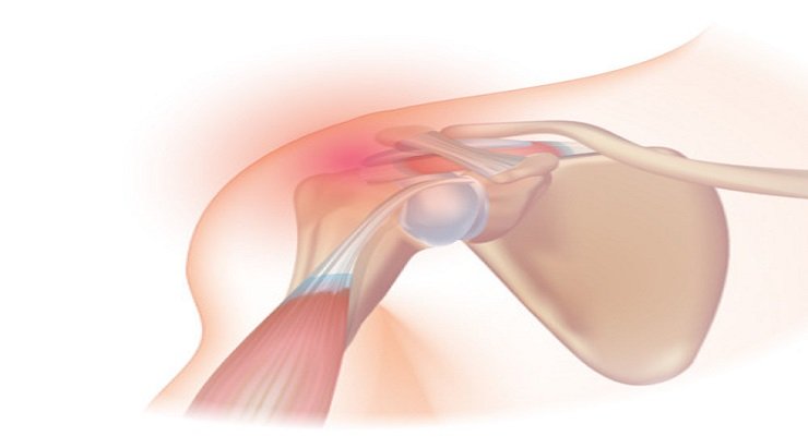How Effective Physical Therapy is for Curing Shoulder Pain