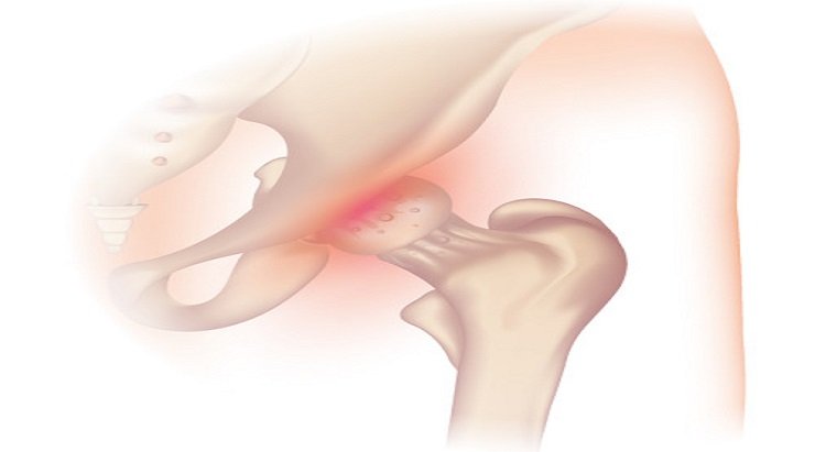 How Effective Physical Therapy is for Curing Hip Pain